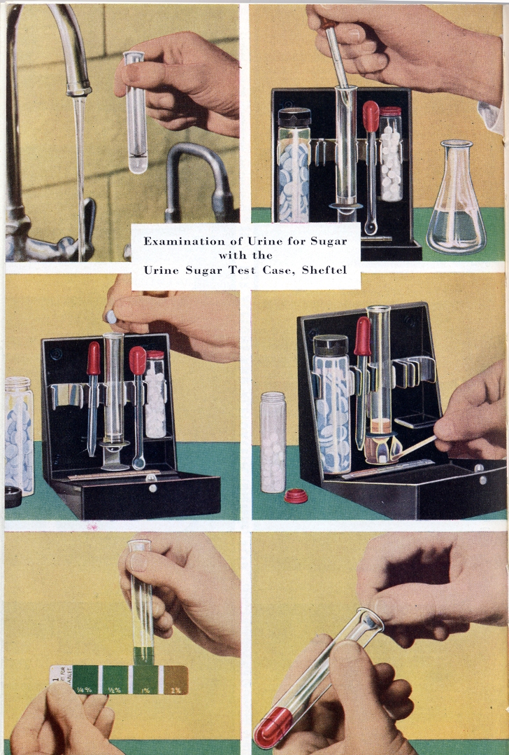 Examination of Urine for Sugar with the Urine Sugar Test Case, Sheftel